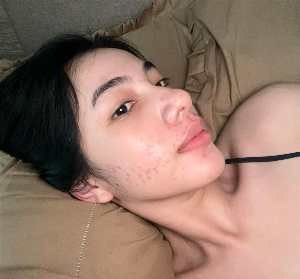 Đẹp như Cẩm Đan cũng bị mụn hành cho nhan sắc hoang toàn-3