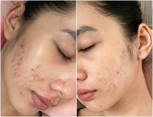 Đẹp như Cẩm Đan cũng bị mụn hành cho nhan sắc hoang toàn-2