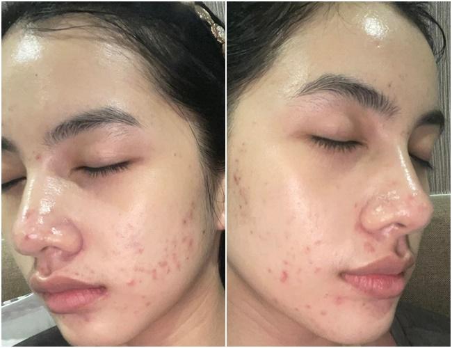 Đẹp như Cẩm Đan cũng bị mụn hành cho nhan sắc hoang toàn-1