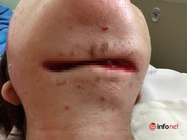 Hotgirl Gen Z suýt đứt cổ sau khi tiêm tan mỡ-1