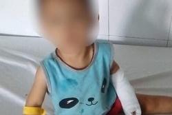 Bé gái 3 tuổi bị chồng hờ của mẹ dùng dao lam cắt đứt gân tay