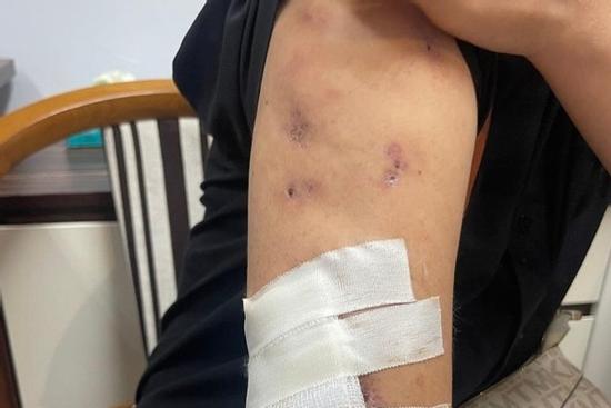 Quý bà thủng hàng chục lỗ trên cơ thể sau khi tiêm chất tan mỡ