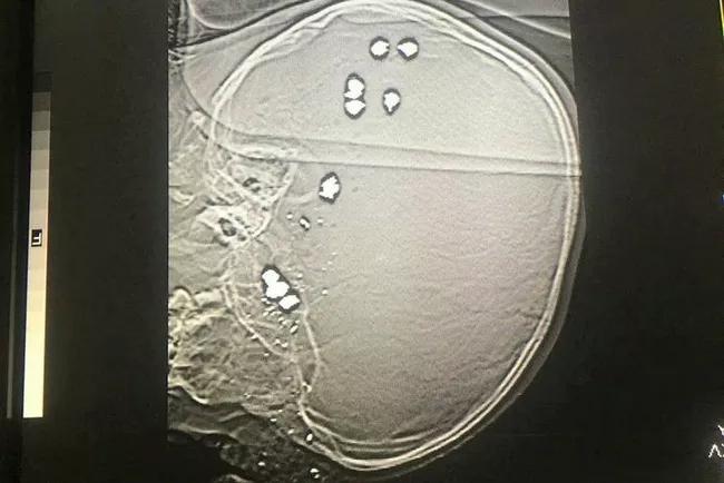 Nghịch súng, bé trai bị 11 viên đạn bi găm vào đầu tử vong-2