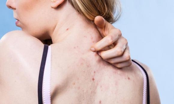 Mách bạn mẹo trị mụn lưng để không bị tái phát trở lại-1