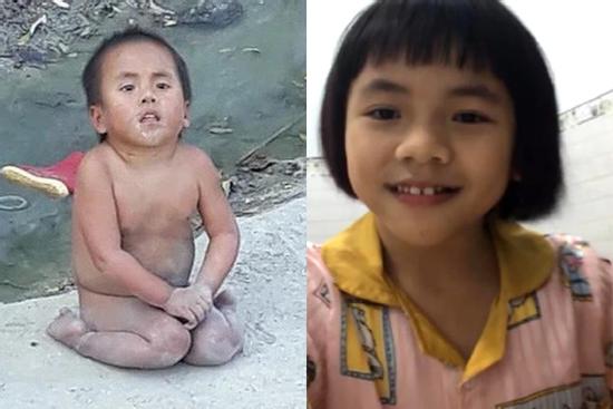 Ngoại hình em bé Mường Lát liệt 2 chân sau 5 năm được nhận nuôi