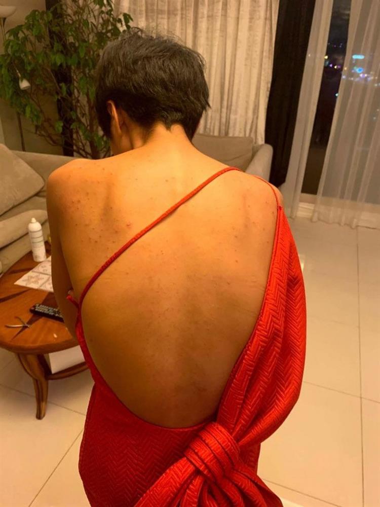 HHen Niê revealed her scary back acne past-3