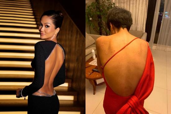 H'Hen Niê hé lộ quá khứ mụn lưng chi chít phát sợ