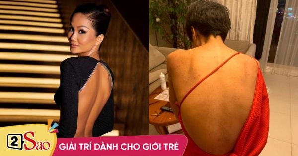 H’Hen Niê revealed her scary back acne past