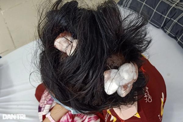 Bé gái 16 tuổi bị người tình của mẹ dùng gậy sắt vụt bất tỉnh-1