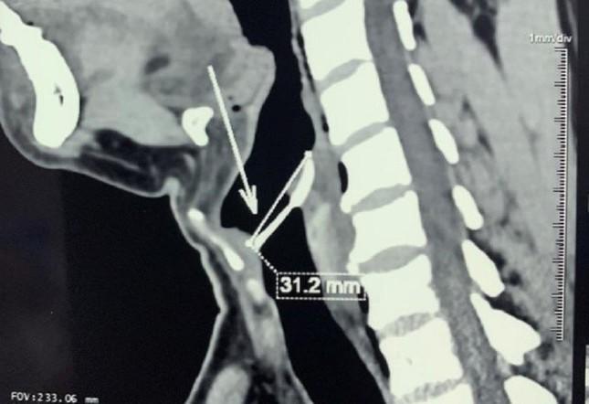 Đang ăn cá bỗng giật mình, xương ghim luôn vào dây thanh quản-1