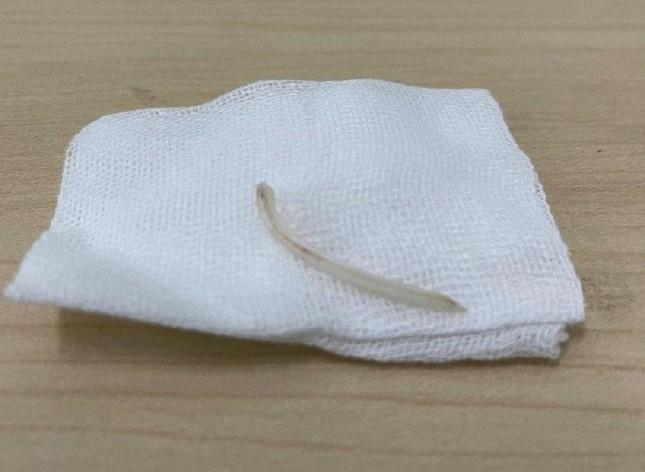 Đang ăn cá bỗng giật mình, xương ghim luôn vào dây thanh quản-2