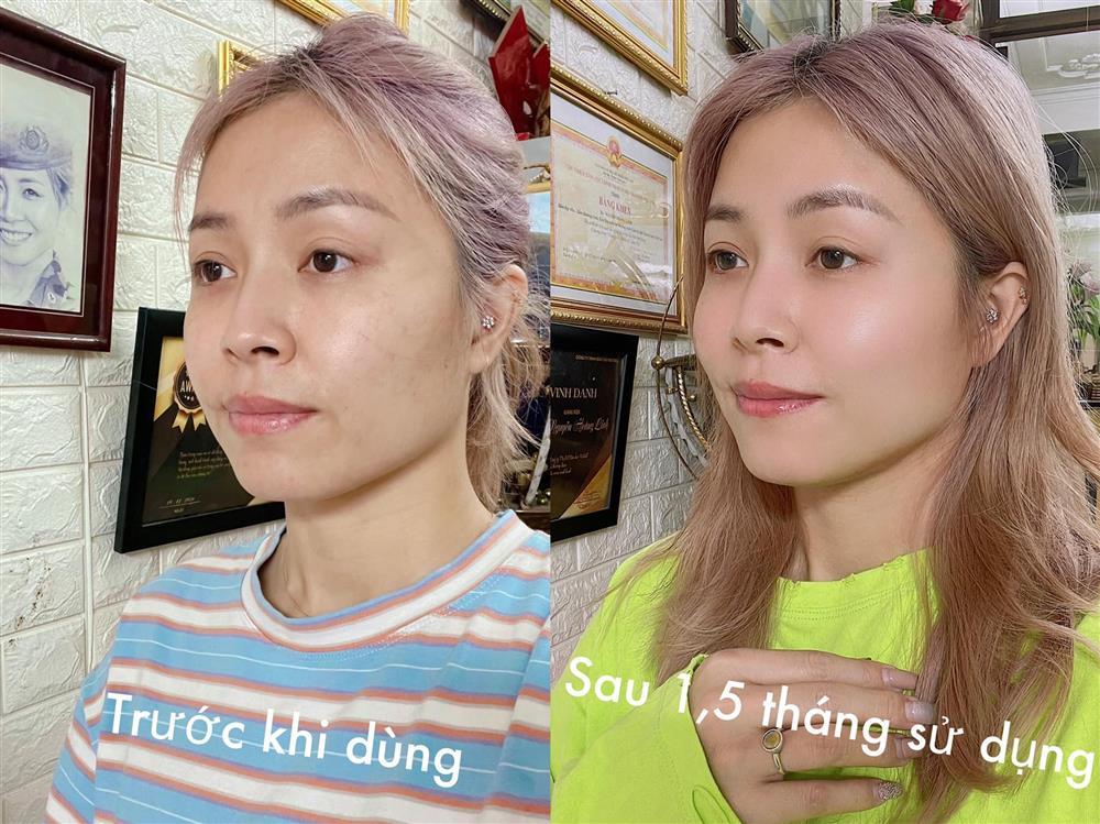 MC Hoàng Linh lộ mặt mộc chi chít nám, tàn nhang-1