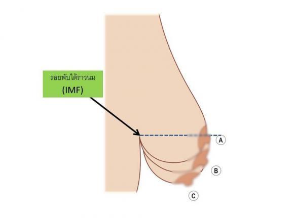 Làm sao biết ngực chảy xệ đang ở mức độ nào và cách khắc phục?-1