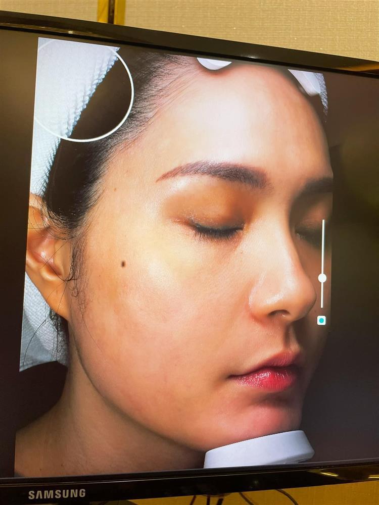 Hết lộ cằm gãy, Đoàn Di Băng xuất hiện với làn da sần sùi-2