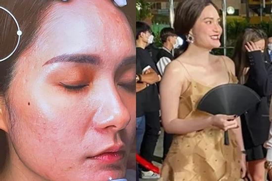 Hết lộ cằm gãy, Đoàn Di Băng xuất hiện với làn da sần sùi