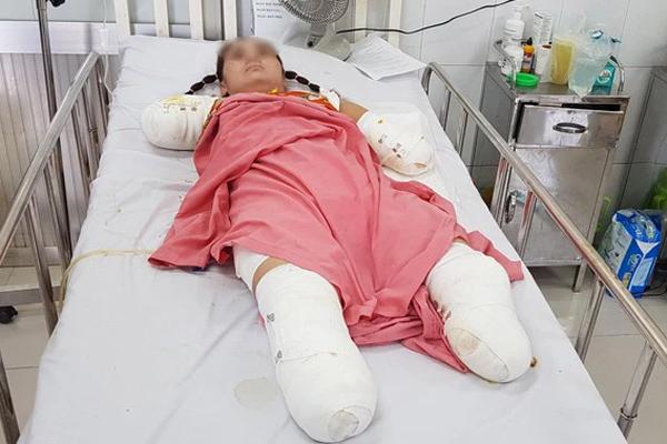 The woman lost all four limbs due to electric shock when she used an iron to pick mangoes for her children-1