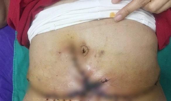 Cảnh báo hút mỡ hỏng: Bác sĩ chỉ ra nguyên nhân tiềm ẩn đằng sau-1