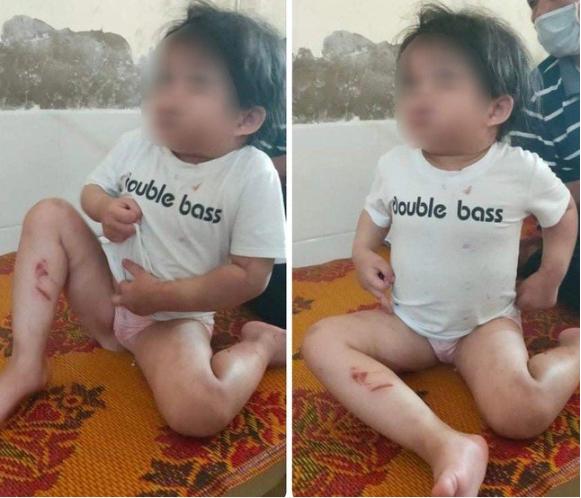 Hà Tĩnh: Bé gái nhập viện đầu rỉ máu, người bầm tím, nghi bị bạo hành-1