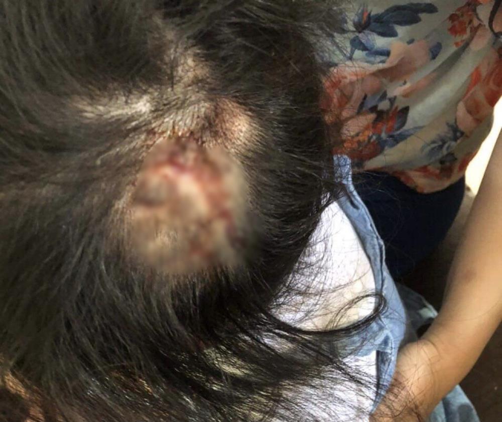 Hà Tĩnh: Bé gái nhập viện đầu rỉ máu, người bầm tím, nghi bị bạo hành-2