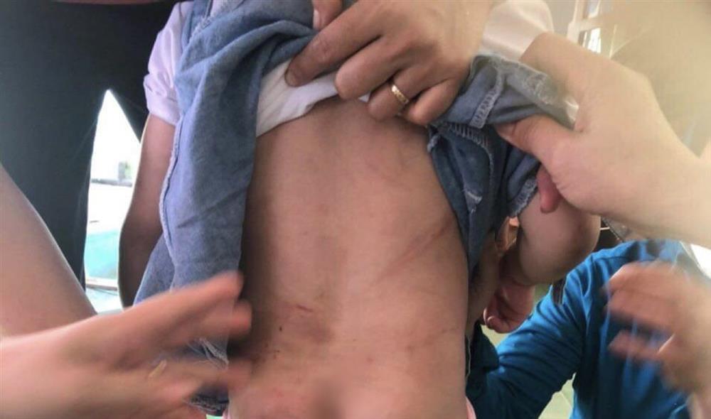 Hà Tĩnh: Bé gái nhập viện đầu rỉ máu, người bầm tím, nghi bị bạo hành-3
