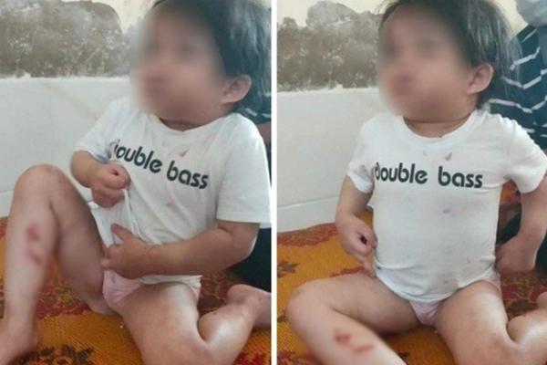 Ha Tinh: The girl was hospitalized with many injuries, suspected of being abused