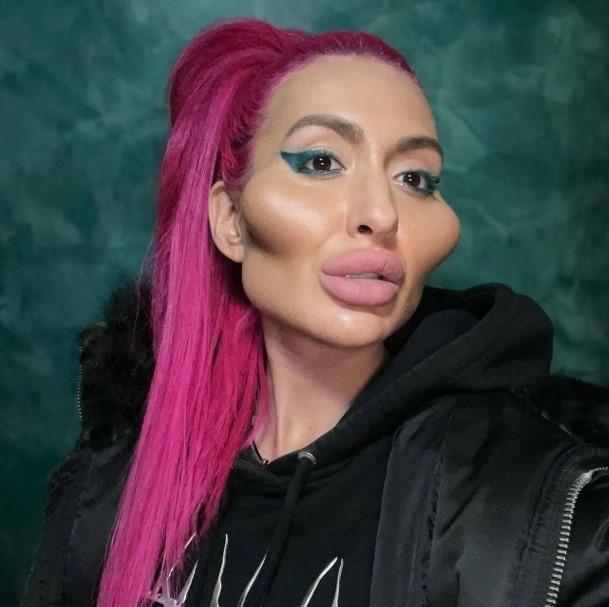 Cô gái chi cả trăm triệu để có gò má cao nhất thế giới-2