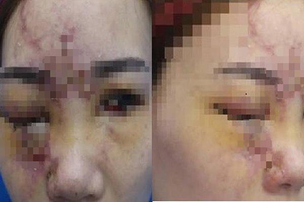 The girl was blind because of filler injection at the hair salon-1