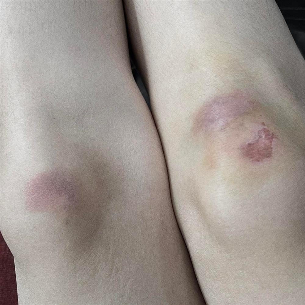 Sơn Tùng bầm dập cả người vì đóng MV nhảy lầu gây sốc-3