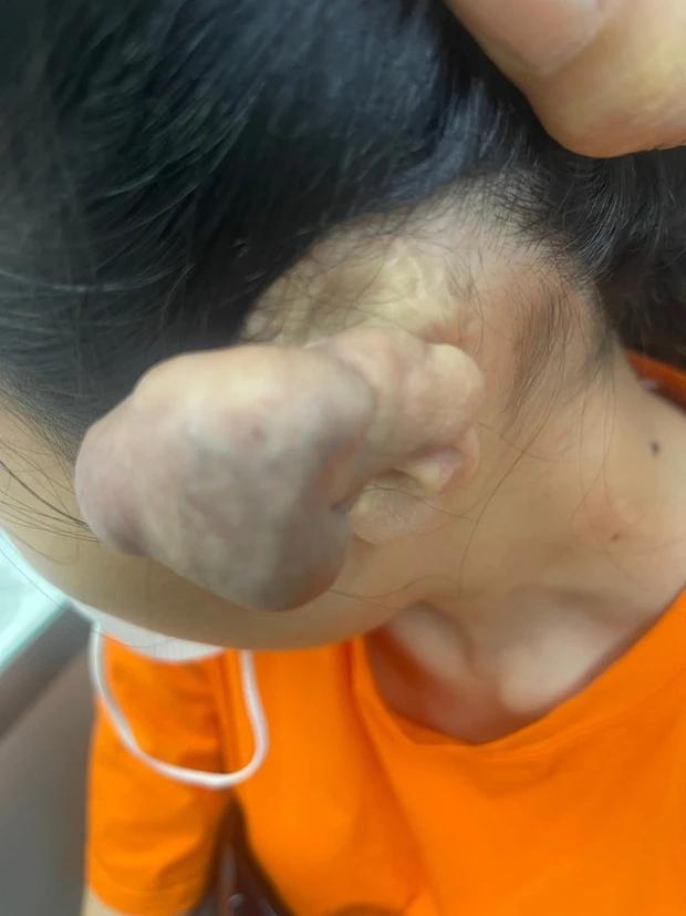 Khối u khủng của cô gái và cảnh báo việc xỏ khuyên khắp cơ thể-1