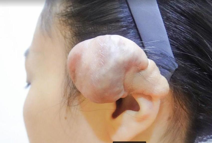 Piercing 6 personalized piercings, the girl deformed her ears, and had to undergo surgery-1