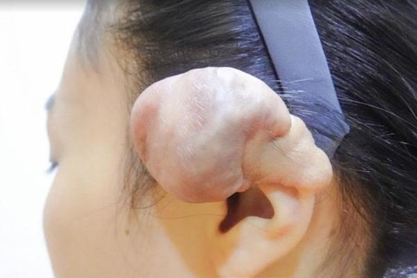 Piercing 6 personality piercings, the girl deformed her ears and had to have surgery