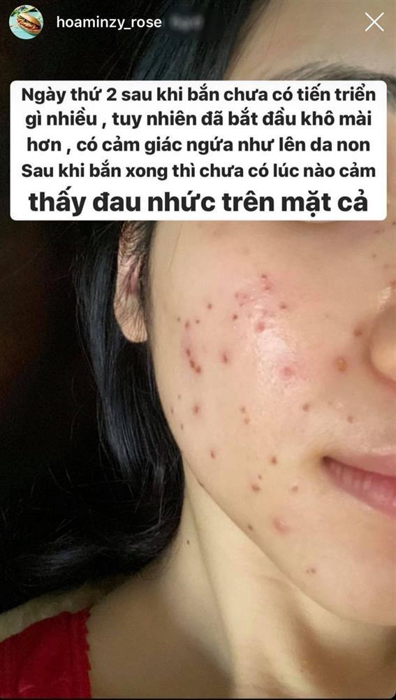 Sau Hòa Minzy, Đoàn Di Băng gây hãi chi chít vết đốt mụn thịt-7