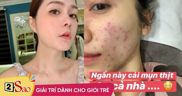 After Hoa Minzy, Doan Di Bang scared her skin with acne scars