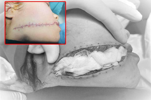 Cãi nhau với vợ, chồng tự đập cánh tay vào kính đứt lìa-3