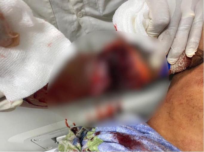 Cãi nhau với vợ, chồng tự đập cánh tay vào kính đứt lìa-1