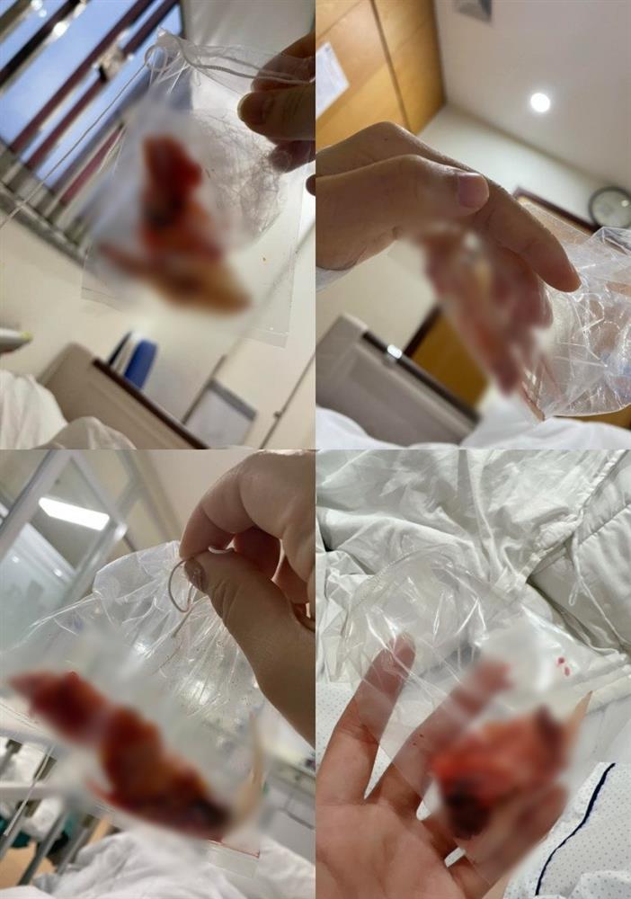 Hết hồn chiến tích xương xẩu sau gọt hàm, hạ gò má của chị em-1