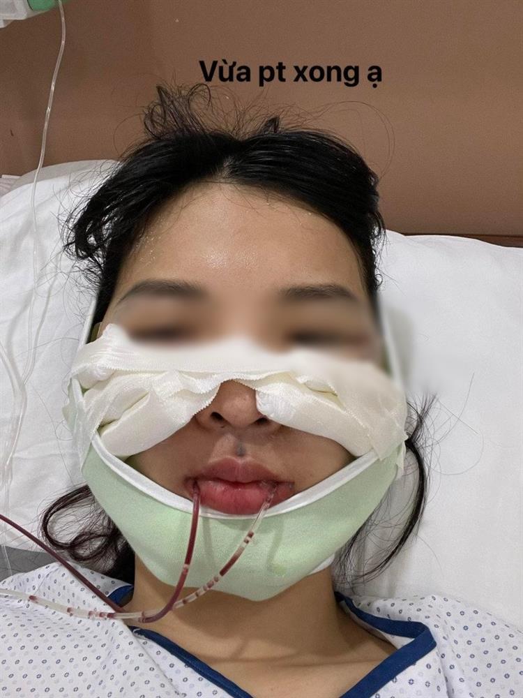Hết hồn chiến tích xương xẩu sau gọt hàm, hạ gò má của chị em-2