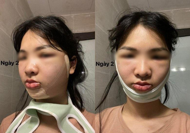 Hết hồn chiến tích xương xẩu sau gọt hàm, hạ gò má của chị em-3