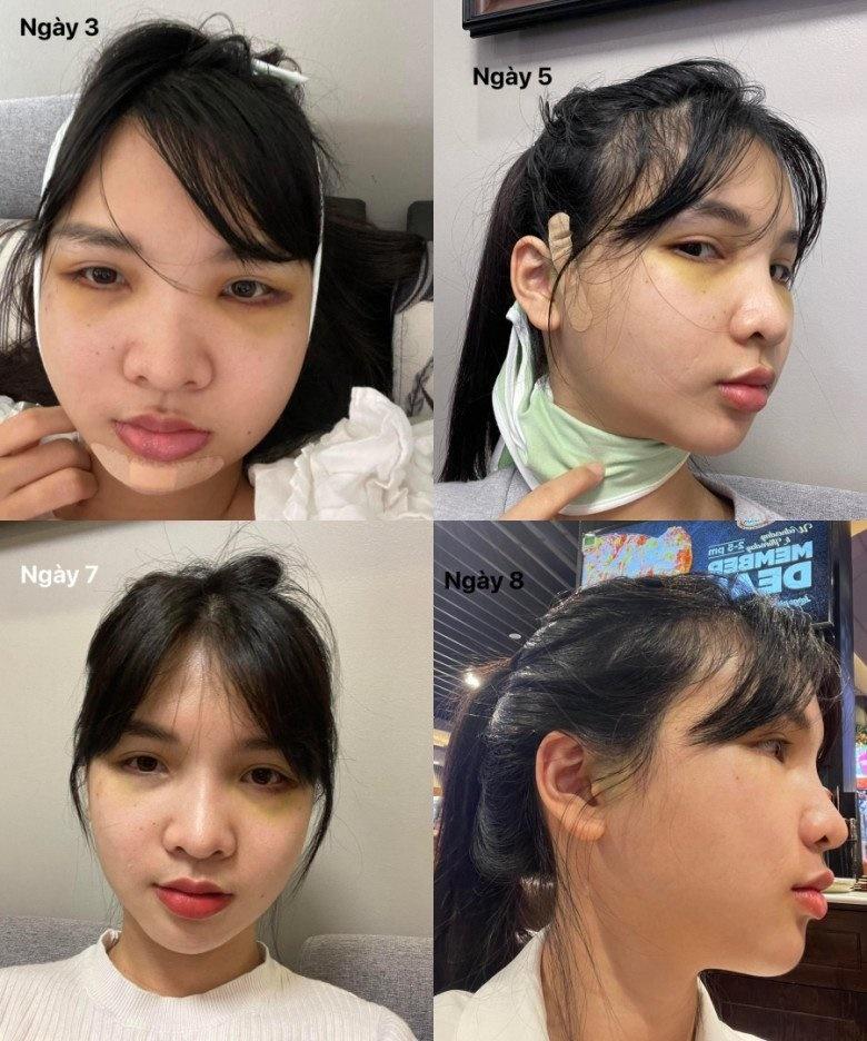 Hết hồn chiến tích xương xẩu sau gọt hàm, hạ gò má của chị em-4