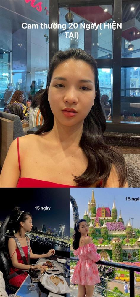 Hết hồn chiến tích xương xẩu sau gọt hàm, hạ gò má của chị em-5