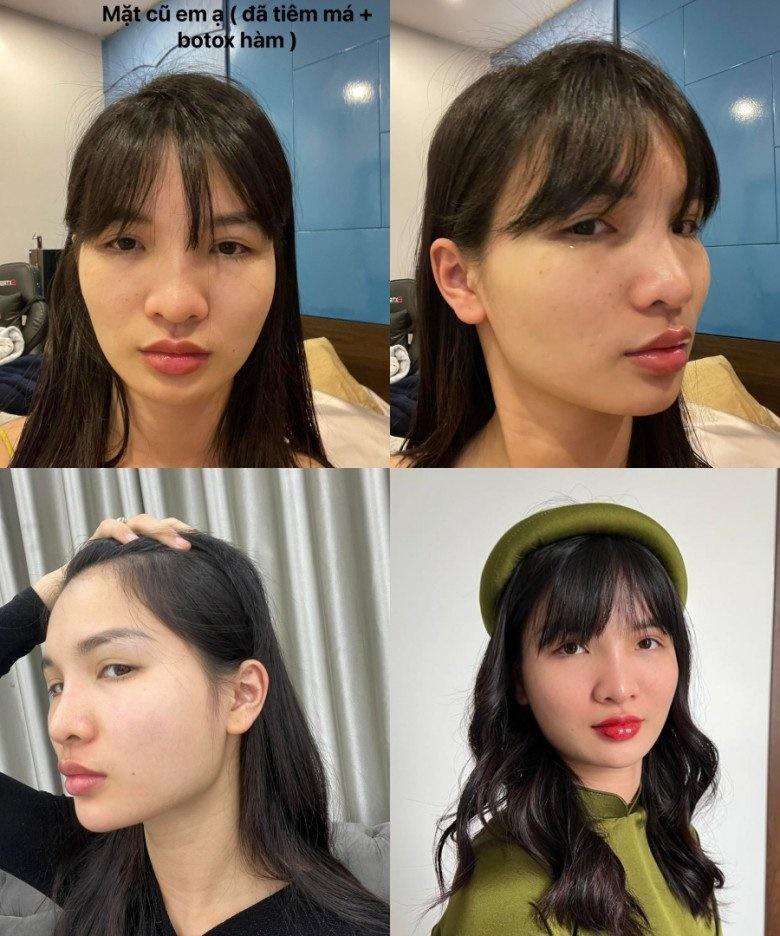 Hết hồn chiến tích xương xẩu sau gọt hàm, hạ gò má của chị em-6