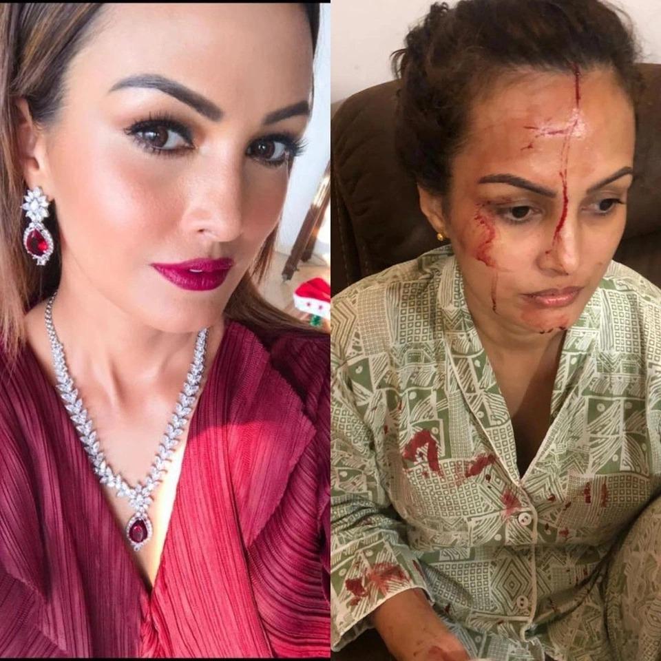 Người mẫu Ấn Độ bị chồng cũ đánh đến xuất huyết não-2