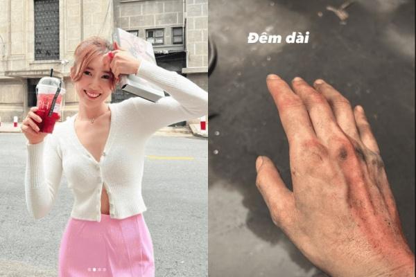 Thuy Ngan makes fans sad with bruised hands for unknown reasons