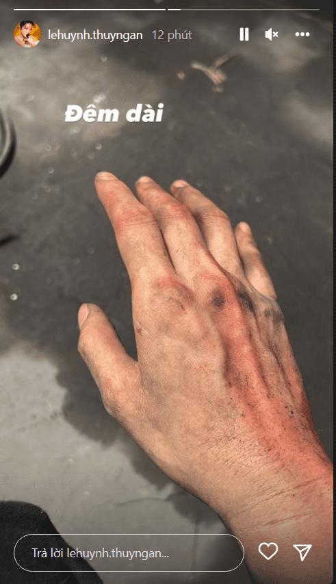 Thúy Ngân khiến fan xót xa với đôi tay bầm dập không rõ lý do-2