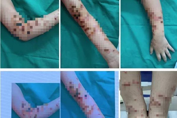 TPHCM: Hàng loạt người vào viện cầu cứu vì đi tắm biển gặp họa bỏng sứa-4