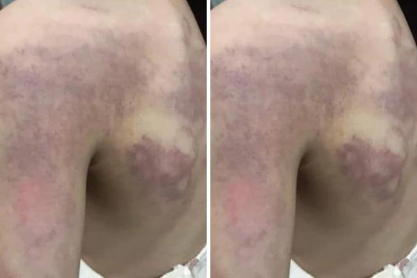 The 3rd grader suspected of being beaten by the teacher because he couldn’t do the homework