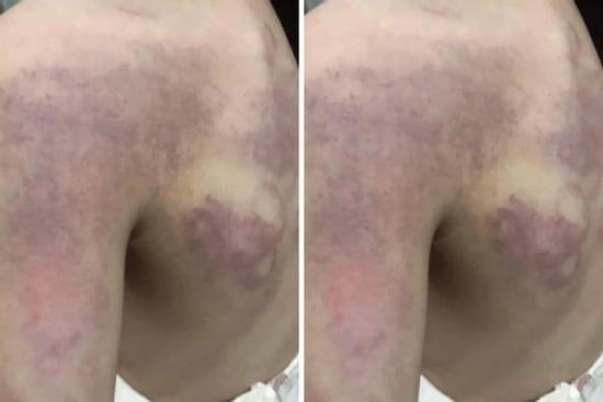 Học sinh lớp 3 nghi bị cô giáo đánh tím người vì... không làm được bài