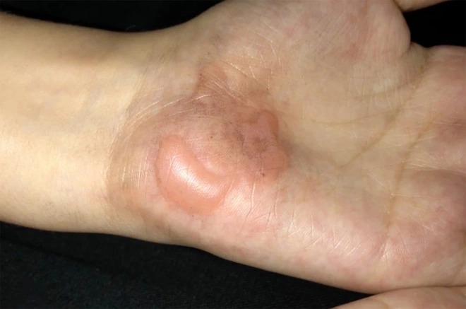 Học sinh ở Mỹ bỏng tay vì bị phạt bò giữa trời nắng 38 độ C-1