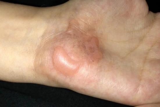 Học sinh ở Mỹ bỏng tay vì bị phạt bò giữa trời nắng 38 độ C