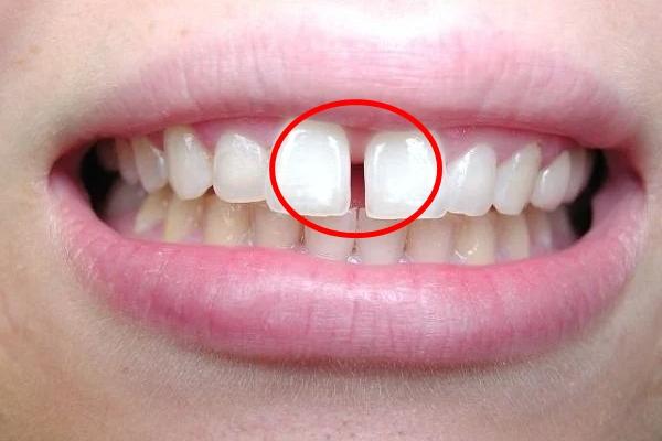 Răng thưa có tác động đến sức khỏe răng miệng không?
